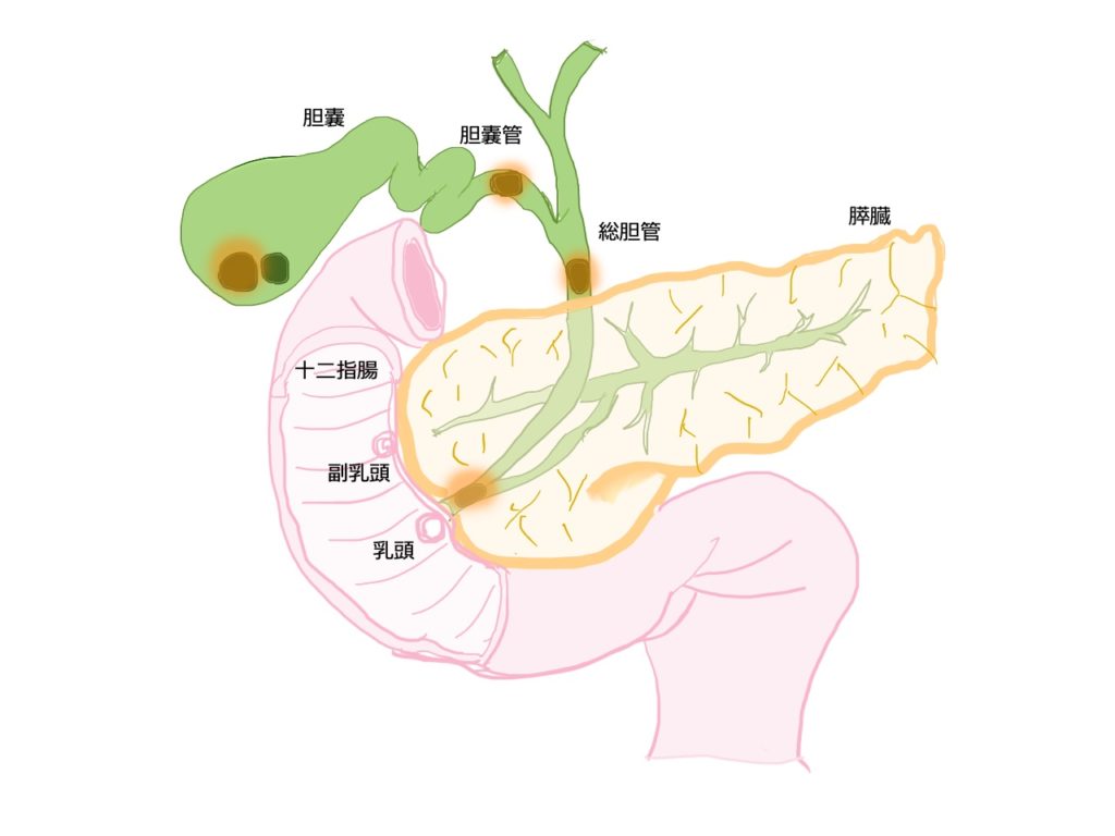 胆嚢炎と胆管炎は共存しない？！ MEDSURG.blog